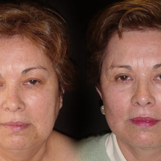 Estiramiento Facial – Caso 1