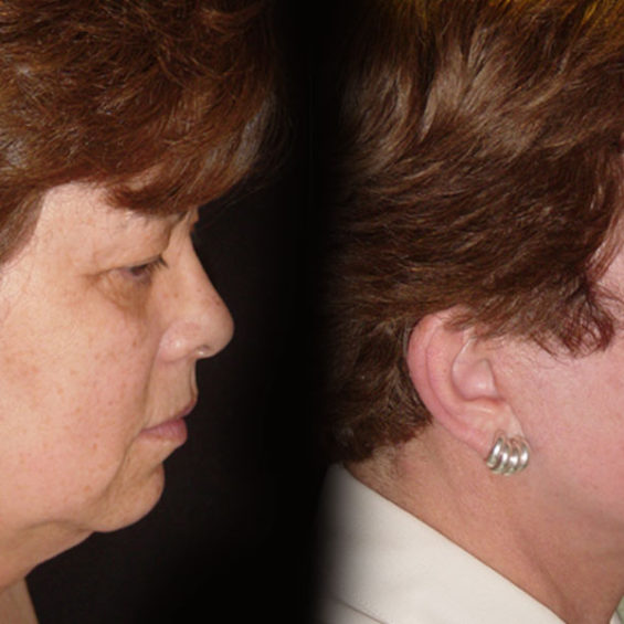 Estiramiento Facial – Caso 1