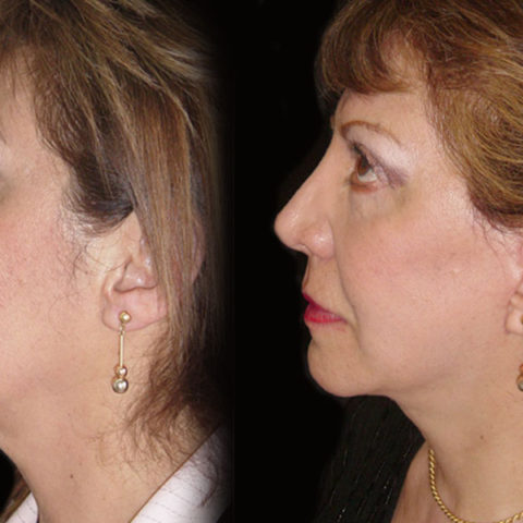 Estiramiento Facial – Caso 3