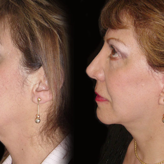 Estiramiento Facial – Caso 3