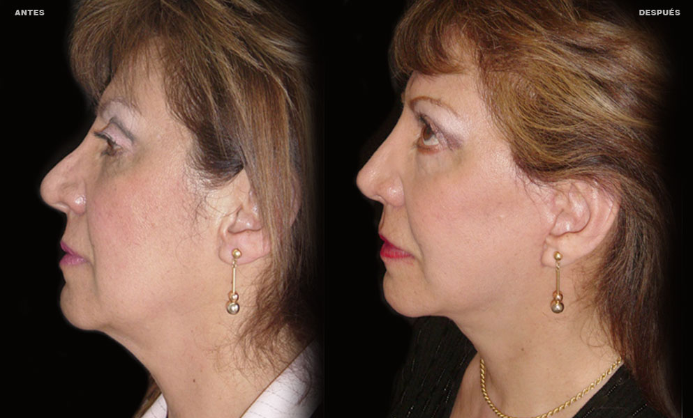 Estiramiento Facial – Caso 3