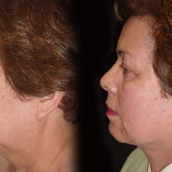 Estiramiento Facial – Caso 1