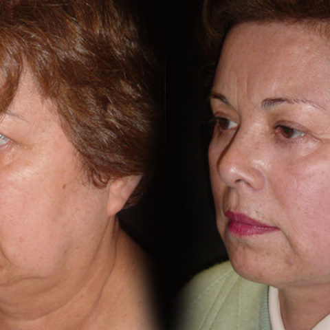 Estiramiento Facial – Caso 1