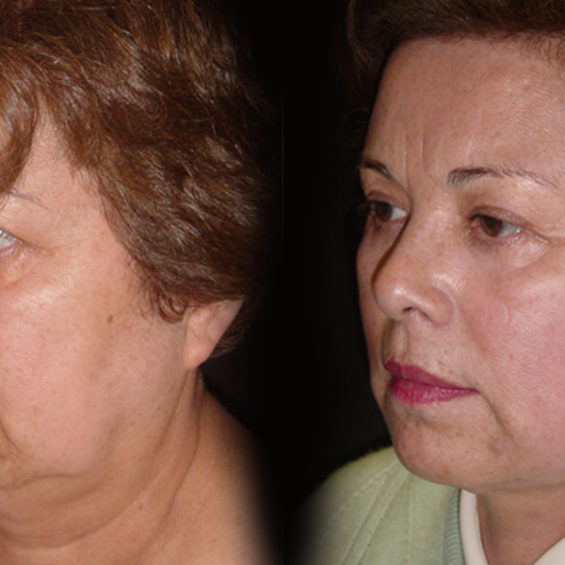 Estiramiento Facial – Caso 1