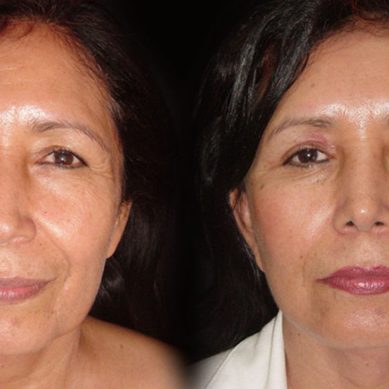 Estiramiento Facial – Caso 2