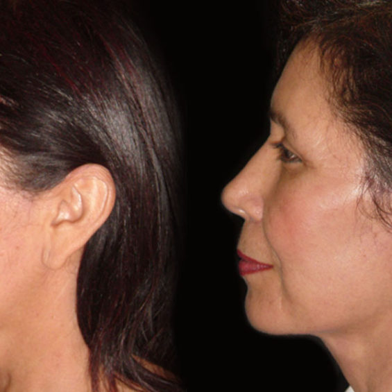 Estiramiento Facial – Caso 2