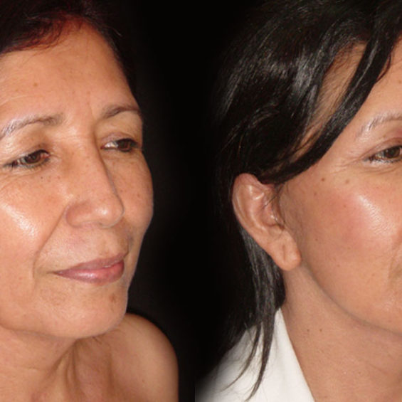 Estiramiento Facial – Caso 2
