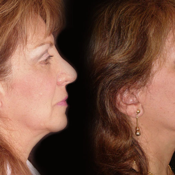 Estiramiento Facial – Caso 3