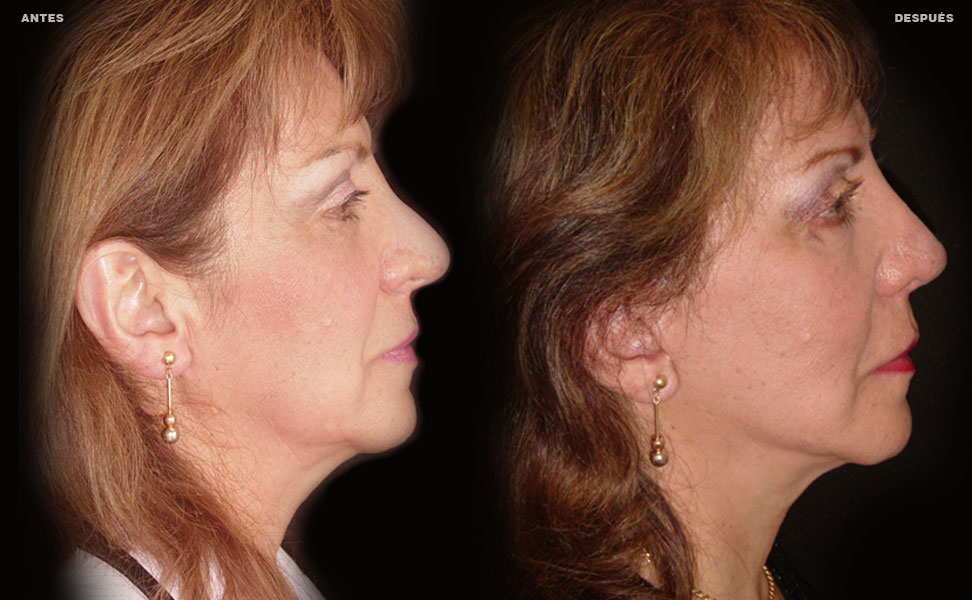 Estiramiento Facial – Caso 3