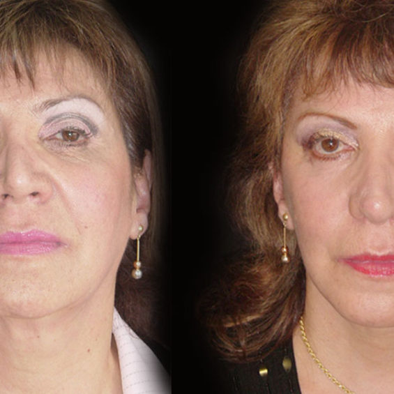 Estiramiento Facial – Caso 3