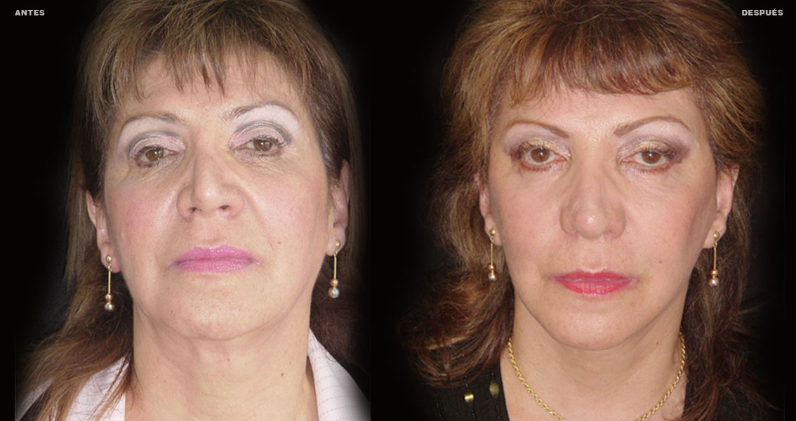 Estiramiento Facial – Caso 3