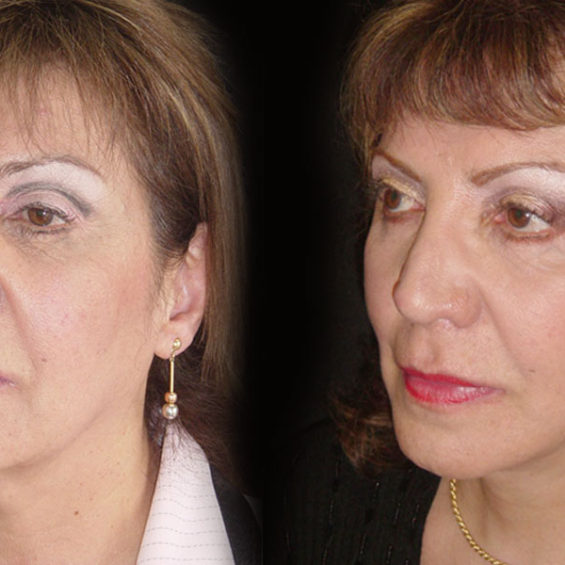 Estiramiento Facial – Caso 3