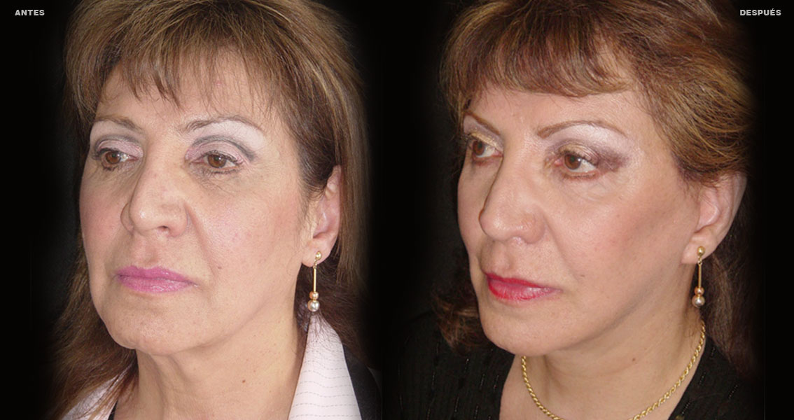 Estiramiento Facial – Caso 3