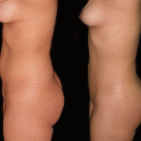 Lipoescultura – Caso 1