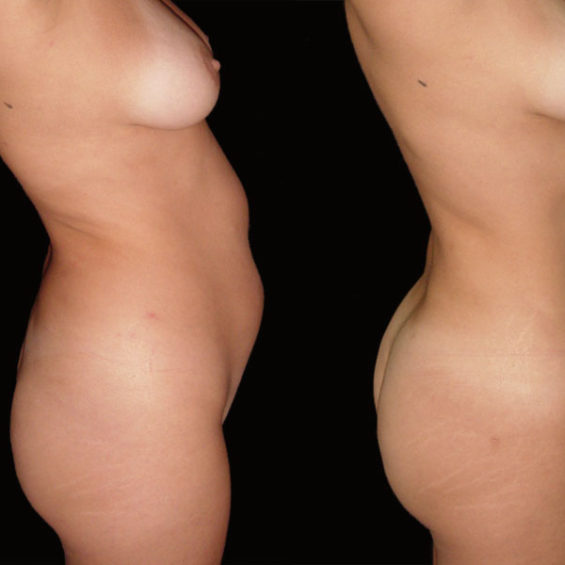 Lipoescultura – Caso 3