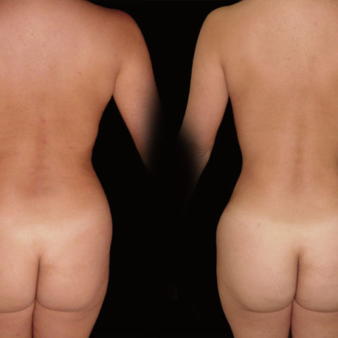 Lipoescultura – Caso 3