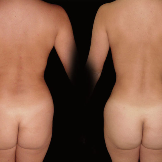 Lipoescultura – Caso 3
