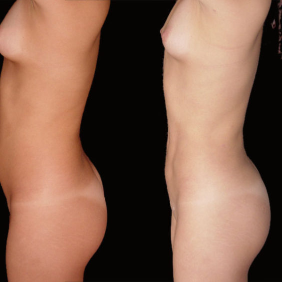 Lipoescultura – Caso 4