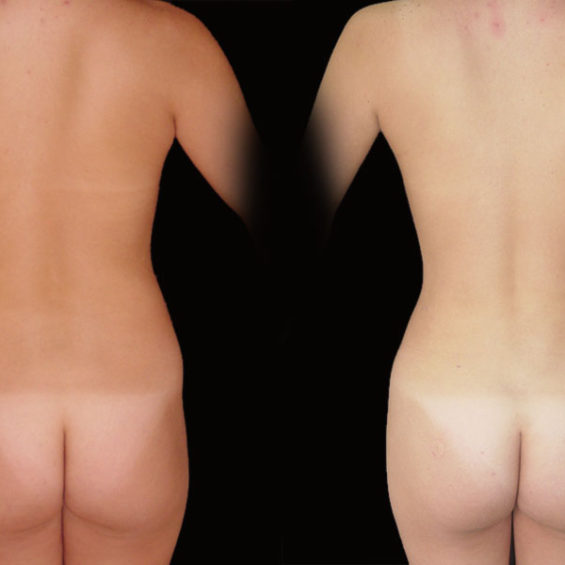 Lipoescultura – Caso 4