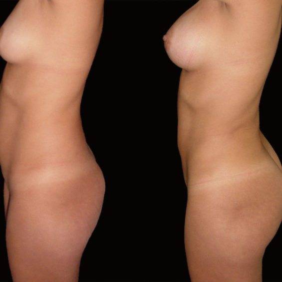 Lipoescultura – Caso 5