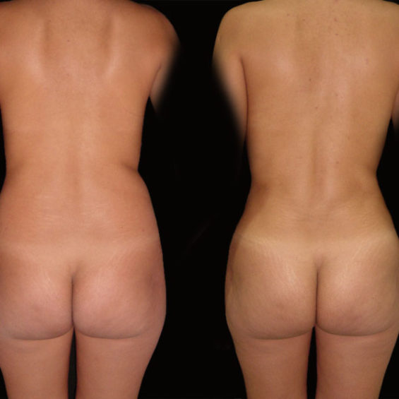 Lipoescultura – Caso 5