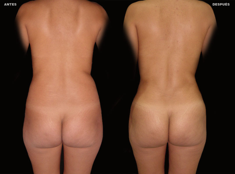 Lipoescultura – Caso 5