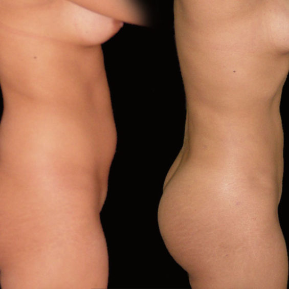 Lipoescultura – Caso 1