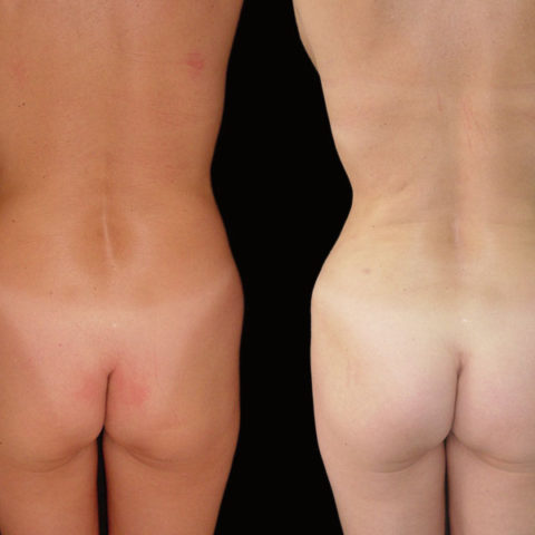 Lipoescultura – Caso 1