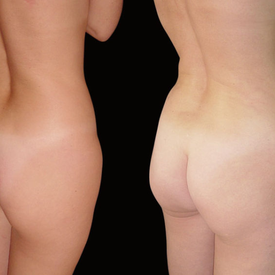 Lipoescultura – Caso 2