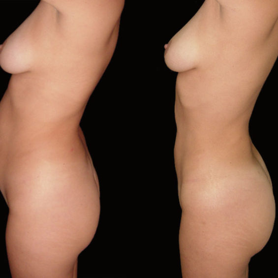 Lipoescultura – Caso 3