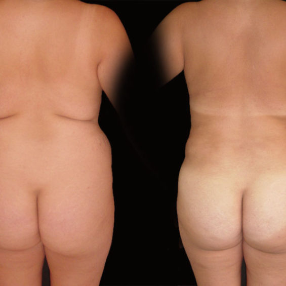 Abdominoplastia – Caso 2