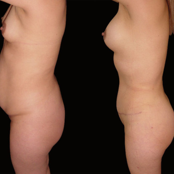 Abdominoplastia – Caso 3