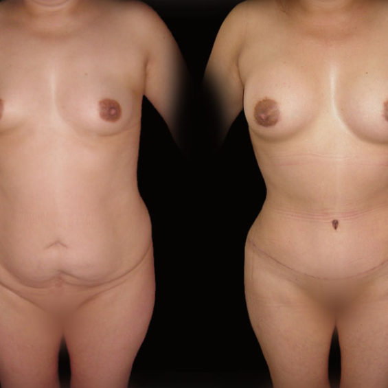 Abdominoplastia – Caso 3