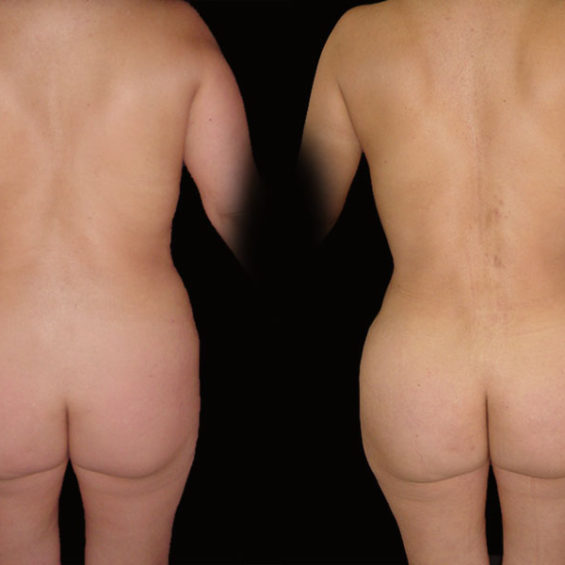 Abdominoplastia – Caso 3