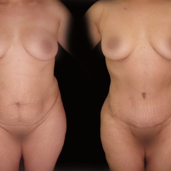 Abdominoplastia – Caso 4