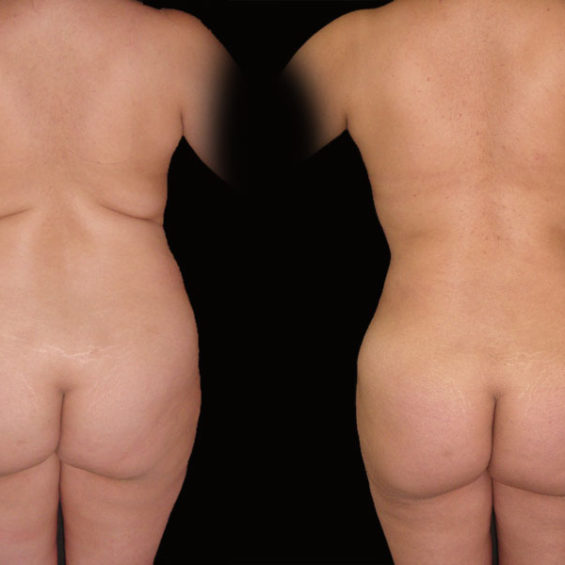 Abdominoplastia – Caso 4