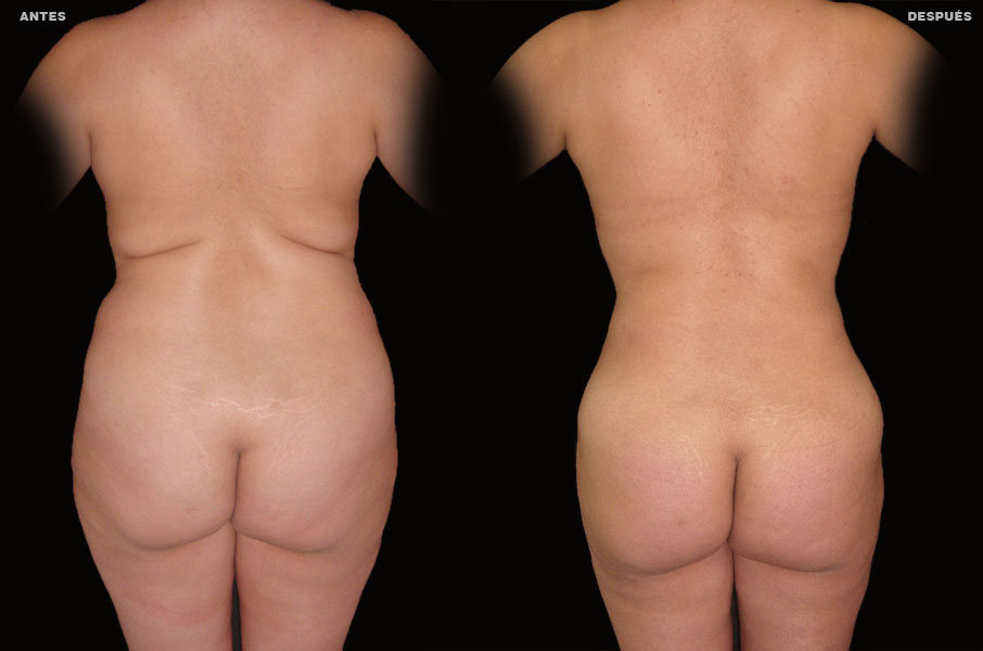 Abdominoplastia – Caso 4