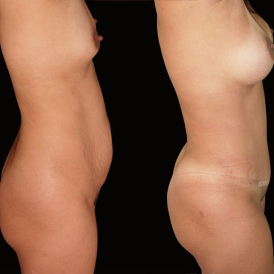 Abdominoplastia – Caso 1
