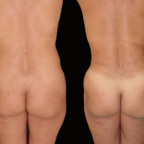Abdominoplastia – Caso 1