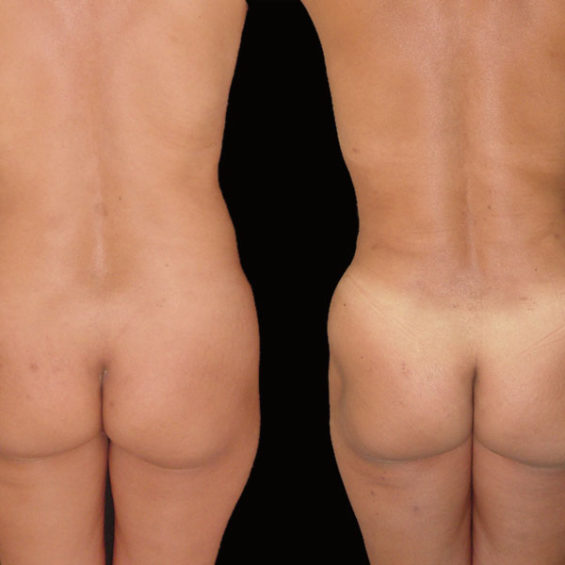 Abdominoplastia – Caso 1