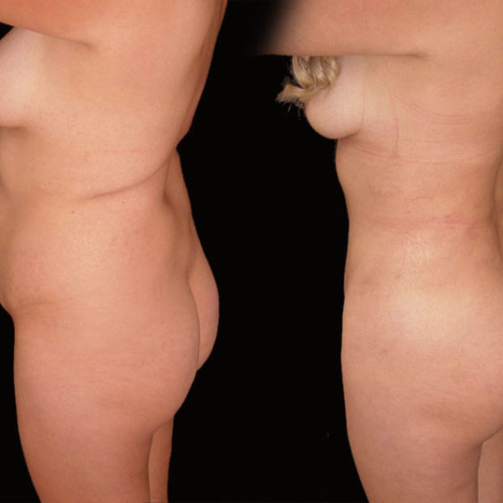 Abdominoplastia – Caso 2