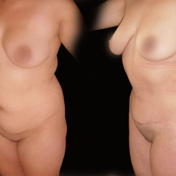 Abdominoplastia – Caso 2