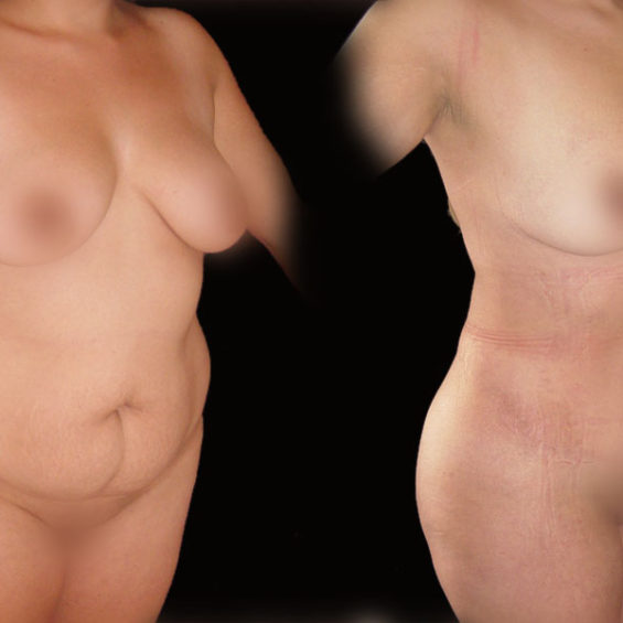 Abdominoplastia – Caso 2